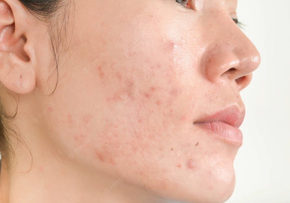 What is acne?