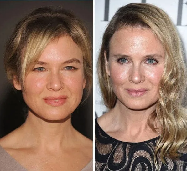 Renée Zellweger Before and After Plastic Surgery | Vanity