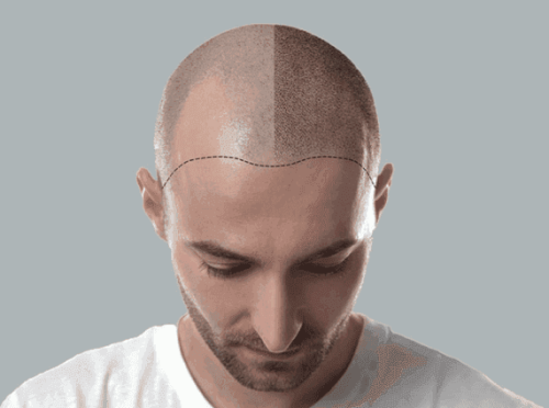 Insights-into-Hairline-Tattooing-and-Scalp-Micropigmentation